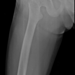 X-RAY FEMUR (AP & LAT)