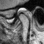 MRI TMJ JOINT