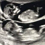 USG TWINS FETAL DOPPLER