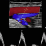 SINGLE LOWER LIMB SINGLE SYSTEM (ARTERY OR VENOUS)