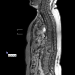 MRI WHOLE SPINE WITH BRAIN CUTS
