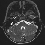 MRI COCHLEA