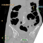 CT COLONOSCOPY