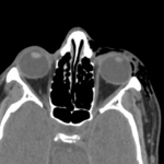 MRI ORBITS