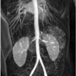 MRI RENAL ANGIO