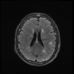 MRI STROKE PROTOCOL