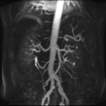 MRI ABDOMEN ANGIOGRAM (NON CONTRAST)