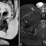 MRI ANAL REGION