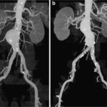 CT AORTA ANGIOGRAM