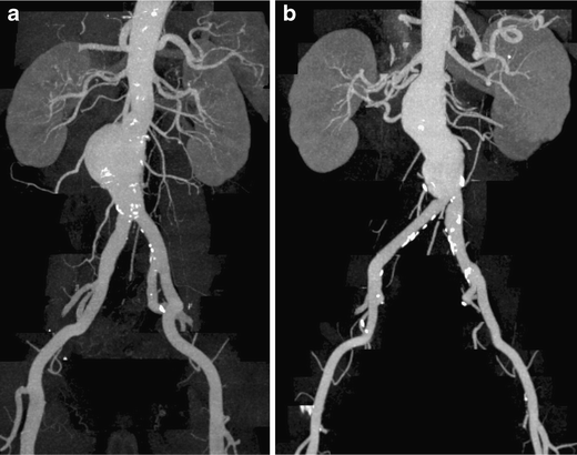 Ct Aorta Angiogram Teleradwin