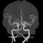 CT BRAIN WITH CEREBRAL ANGIO