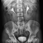 X-RAY IVU (INTRAVENOUS UROGRAPHY)